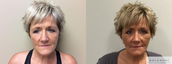 Before & After Facelift Case 378 Front View in Albany & Latham, New York