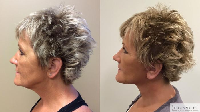 Before & After Facelift Case 378 Left Side View in Albany & Latham, New York