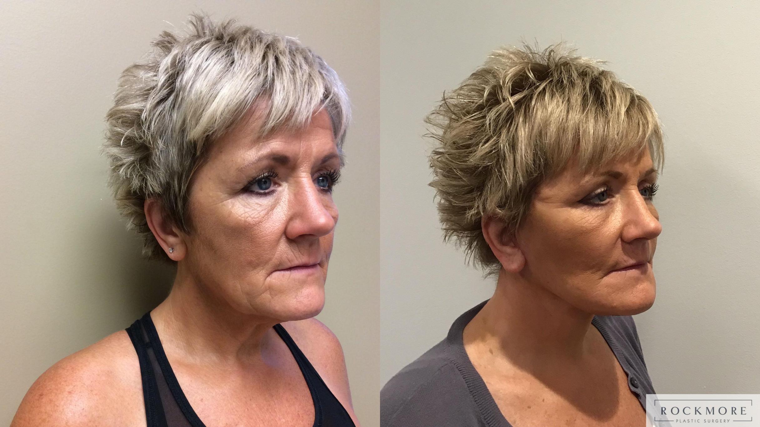 Before & After Facelift Case 378 Right Oblique View in Albany & Latham, New York