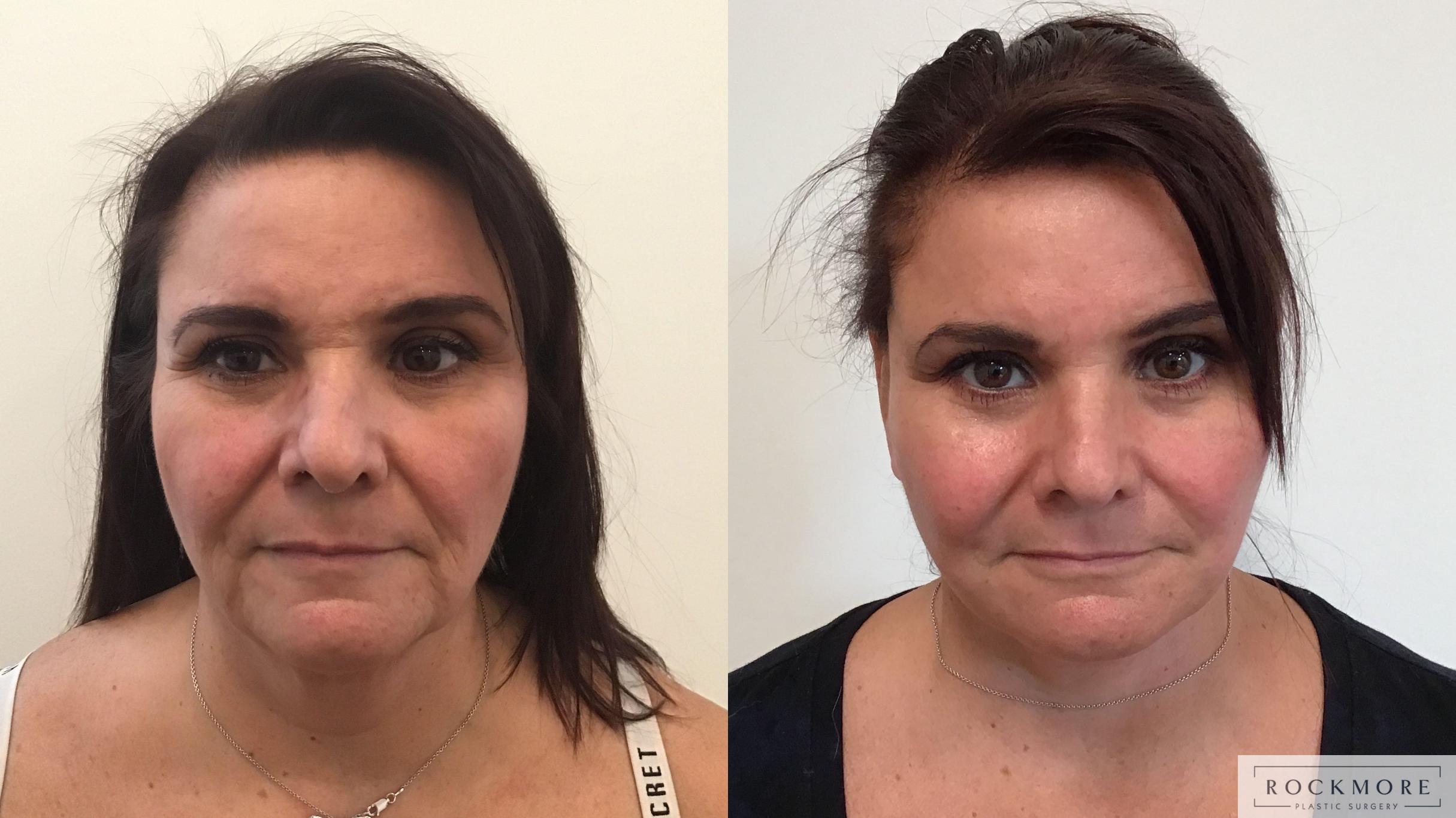 Before & After Facelift Case 396 Front View in Albany & Latham, New York