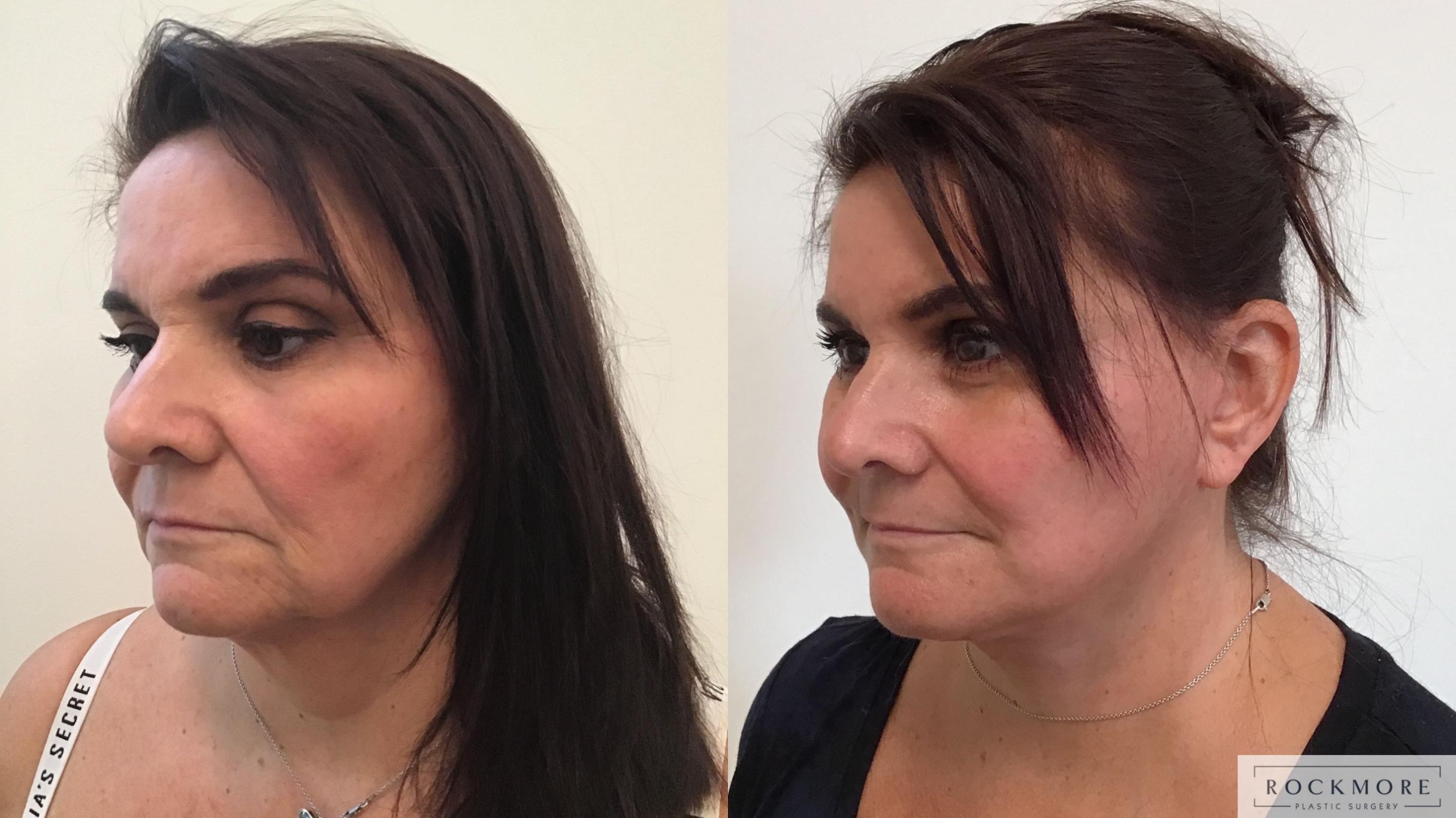 Before & After Facelift Case 396 Left Oblique View in Albany & Latham, New York