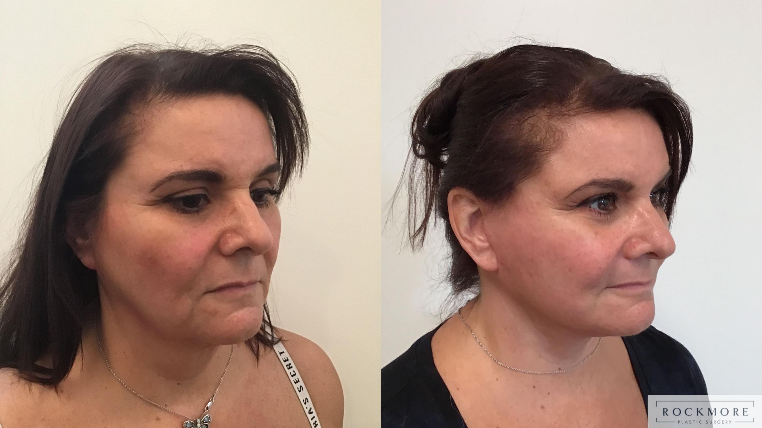 Before & After Facelift Case 396 Right Oblique View in Albany & Latham, New York