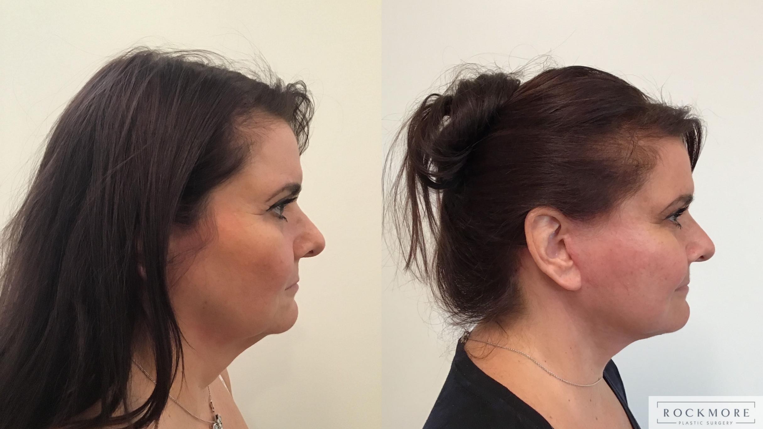 Before & After Facelift Case 396 Right Side View in Albany & Latham, New York