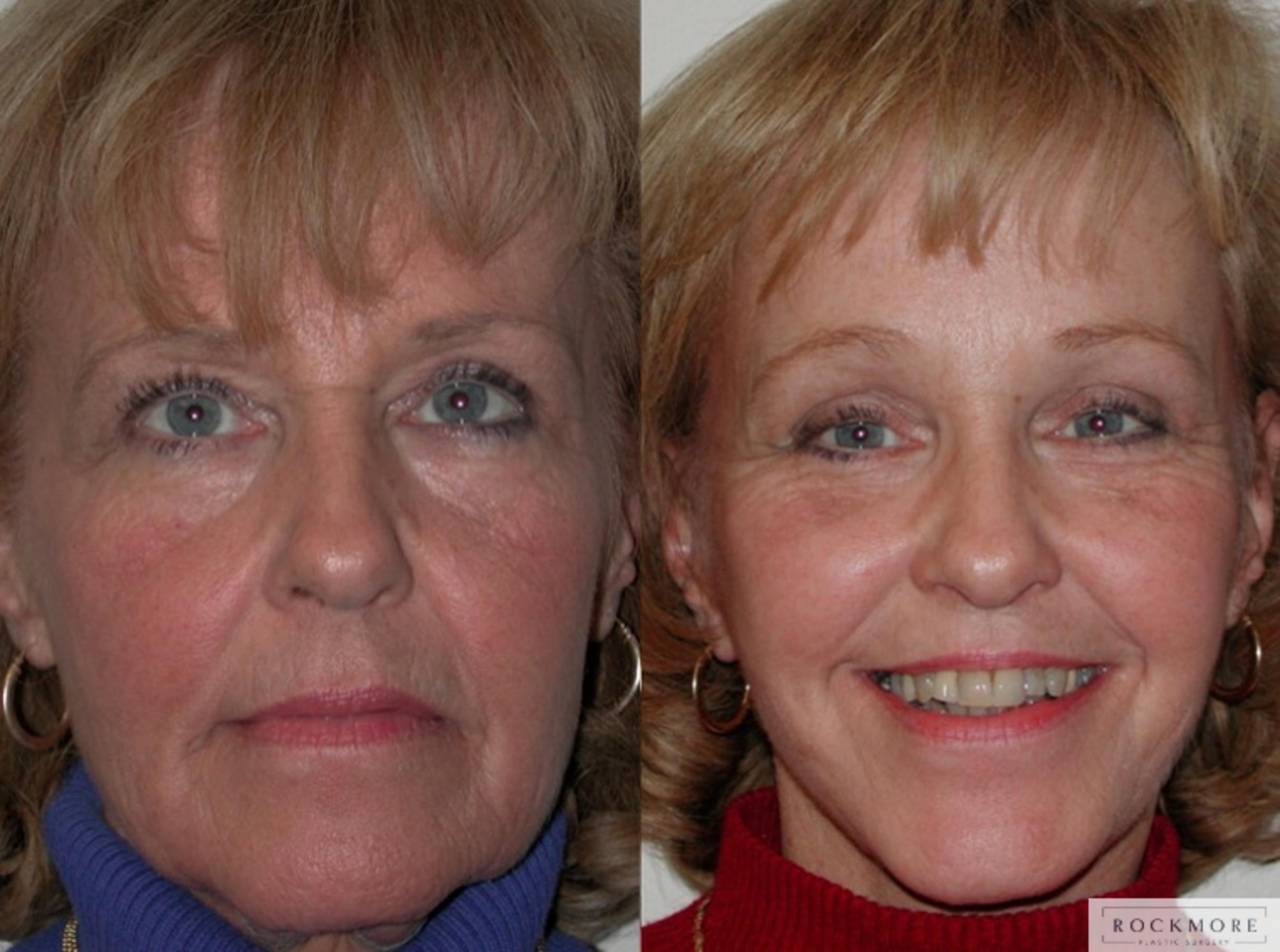 Before & After Facelift Case 40 View #1 View in Albany & Latham, New York
