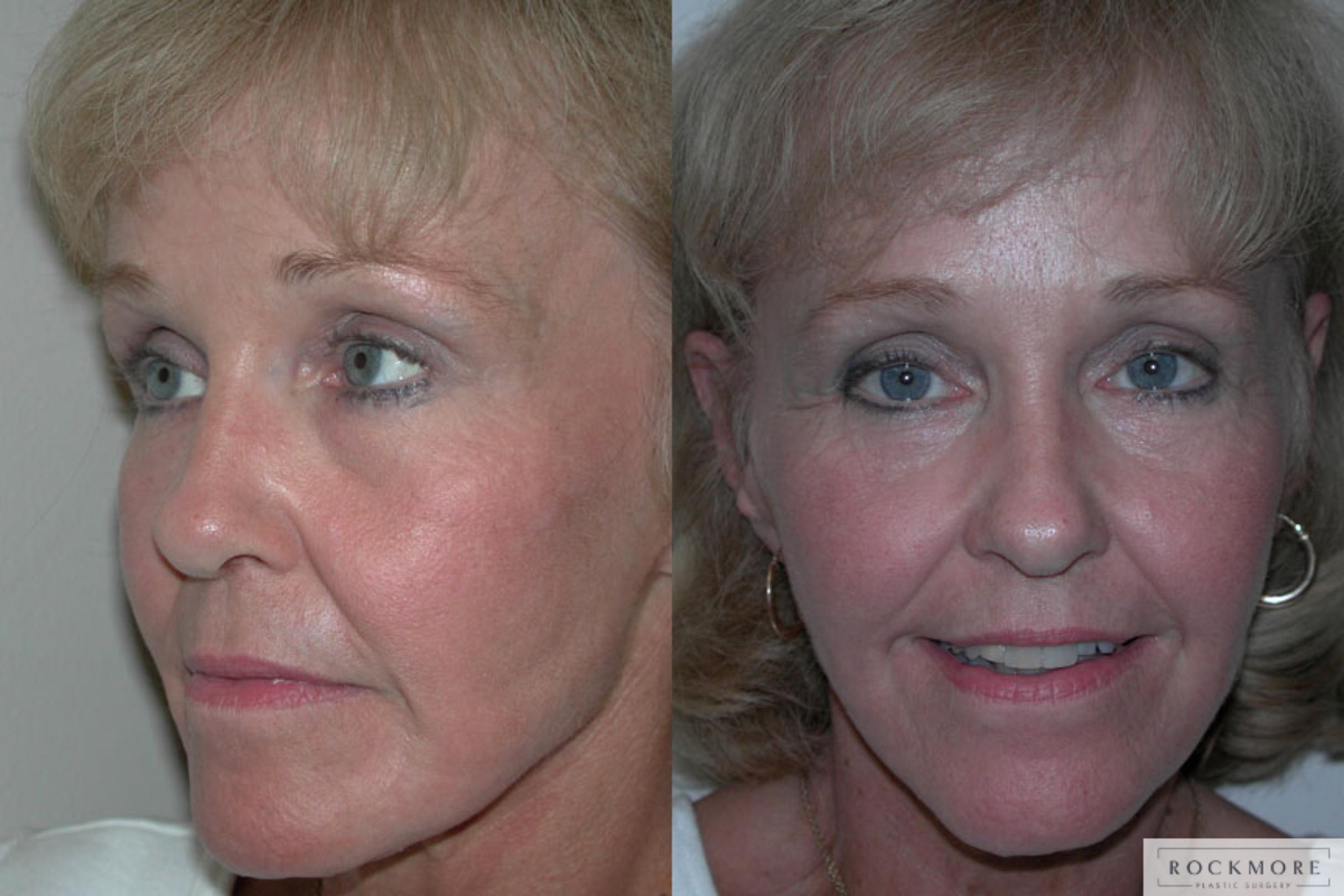 Before & After Facelift Case 40 View #3 View in Albany & Latham, New York