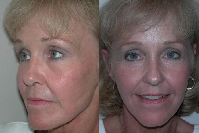 Before & After Facelift Case 40 View #3 View in Albany, Latham & Saratoga, New York