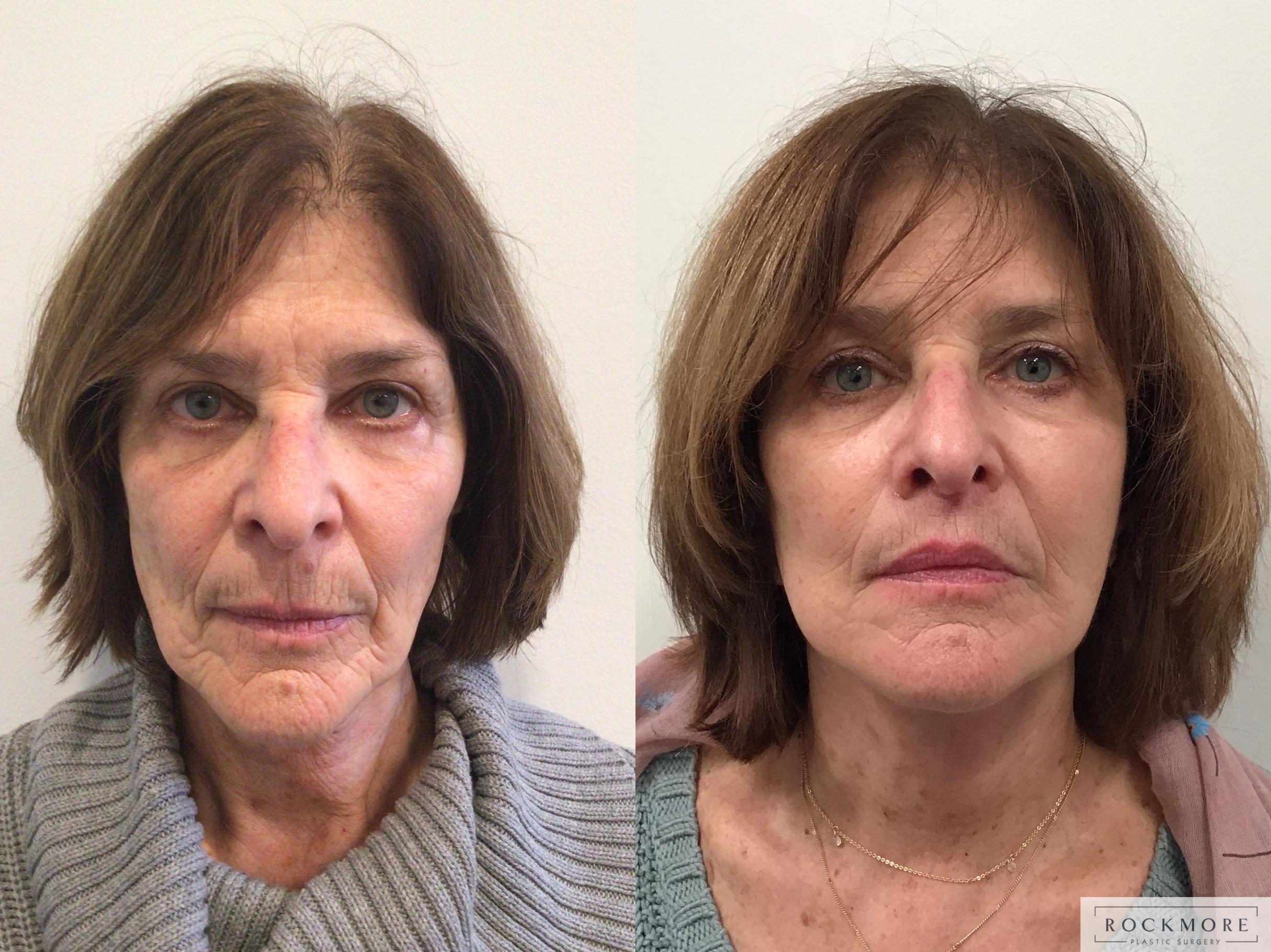 Before & After Facelift Case 408 Front View in Albany & Latham, New York