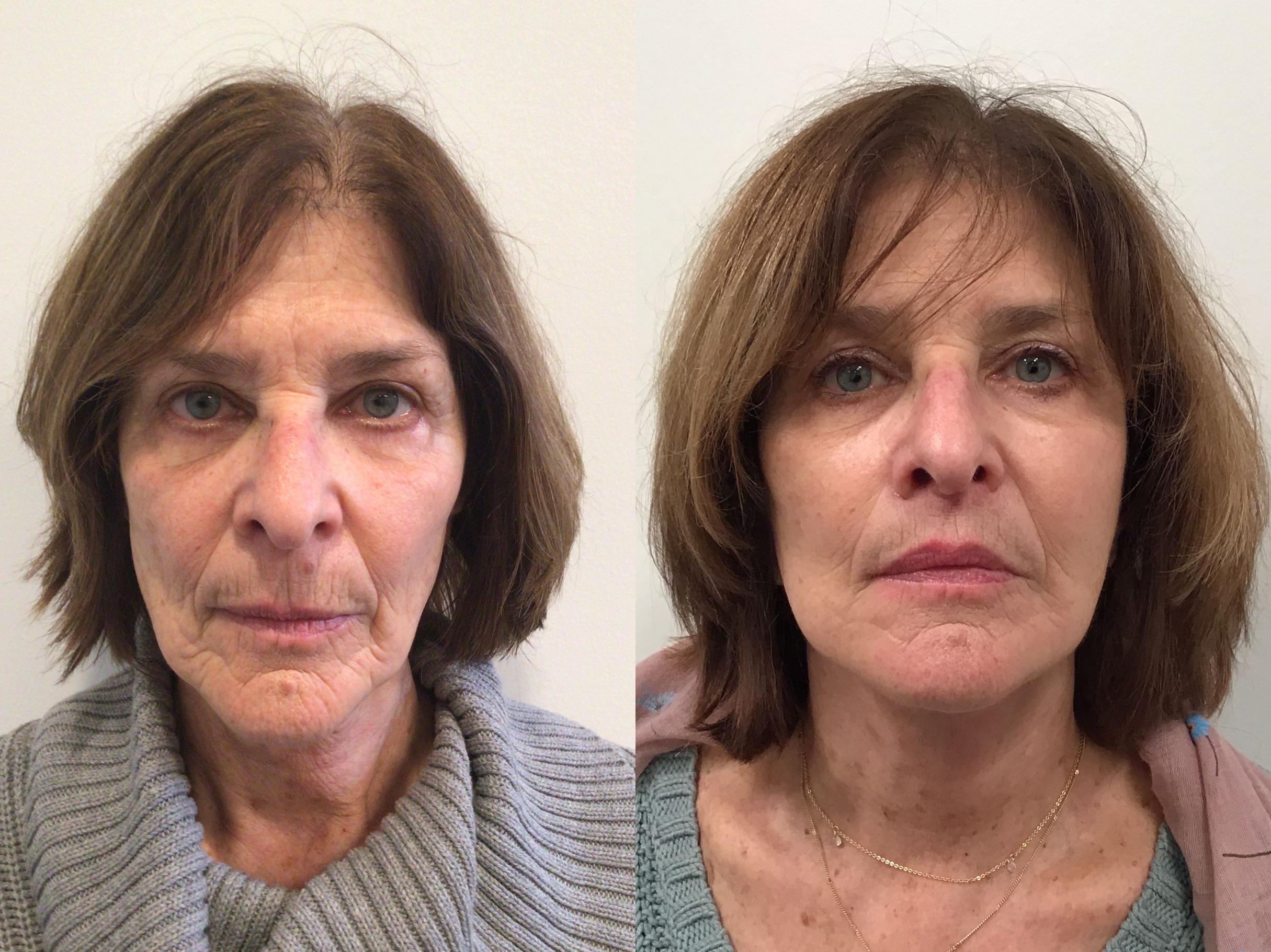 Before & After Facelift Case 408 Front View in Albany & Latham, New York