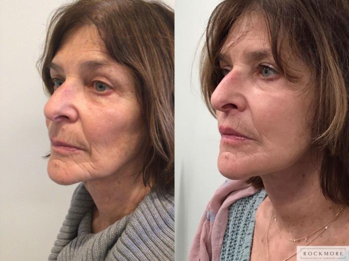 Before & After Neck Lift Case 408 Left Oblique View in Albany & Latham, New York