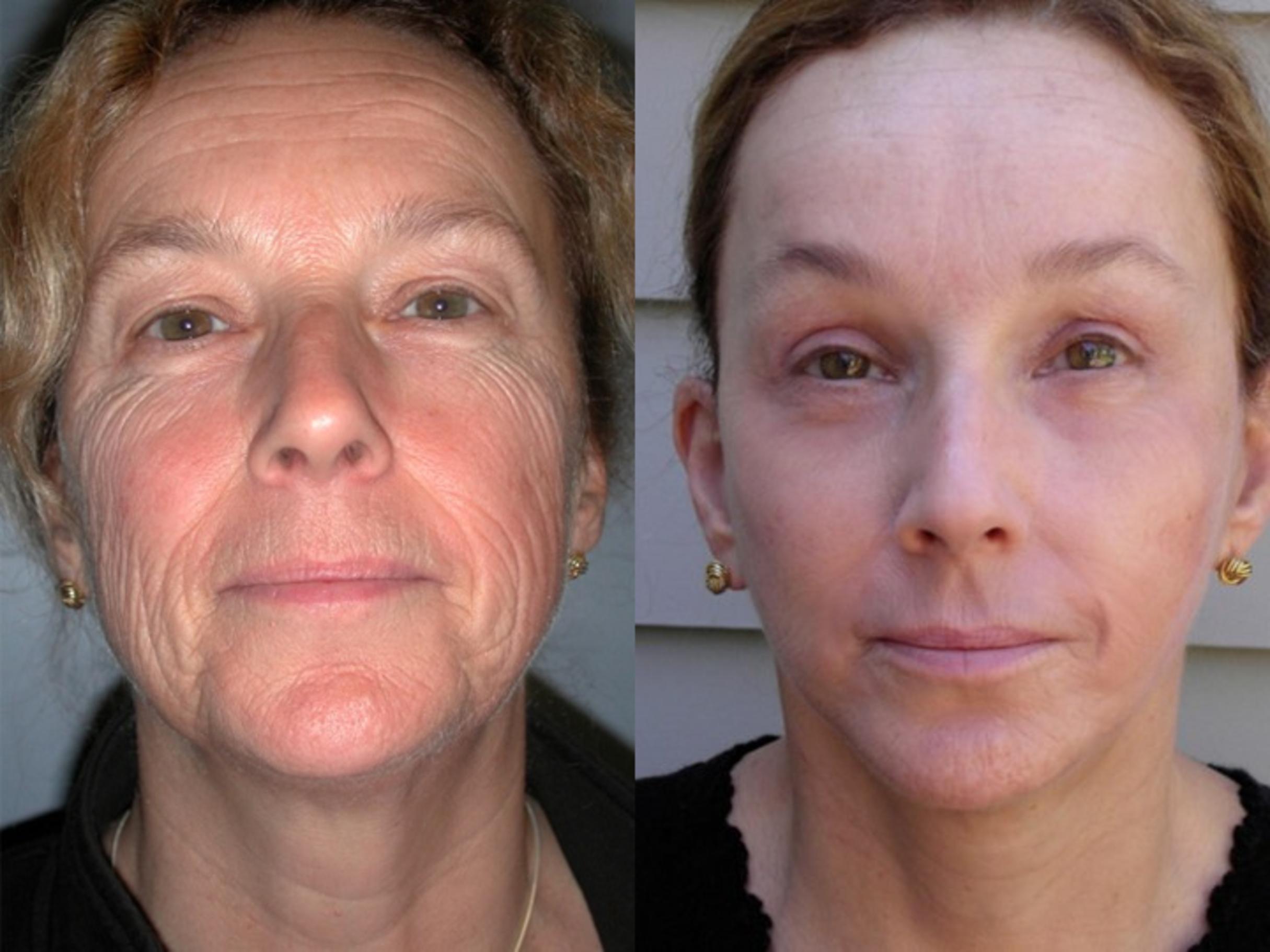 Before & After Facelift Case 41 View #1 View in Albany & Latham, New York