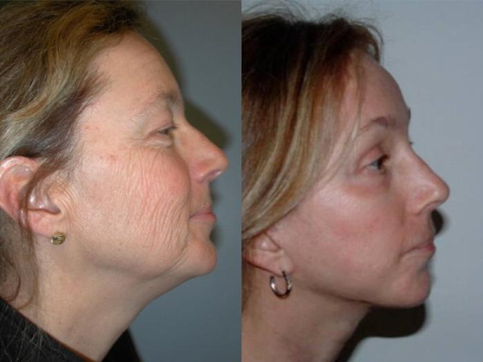 Before & After Facelift Case 41 View #2 View in Albany, Latham & Saratoga, New York