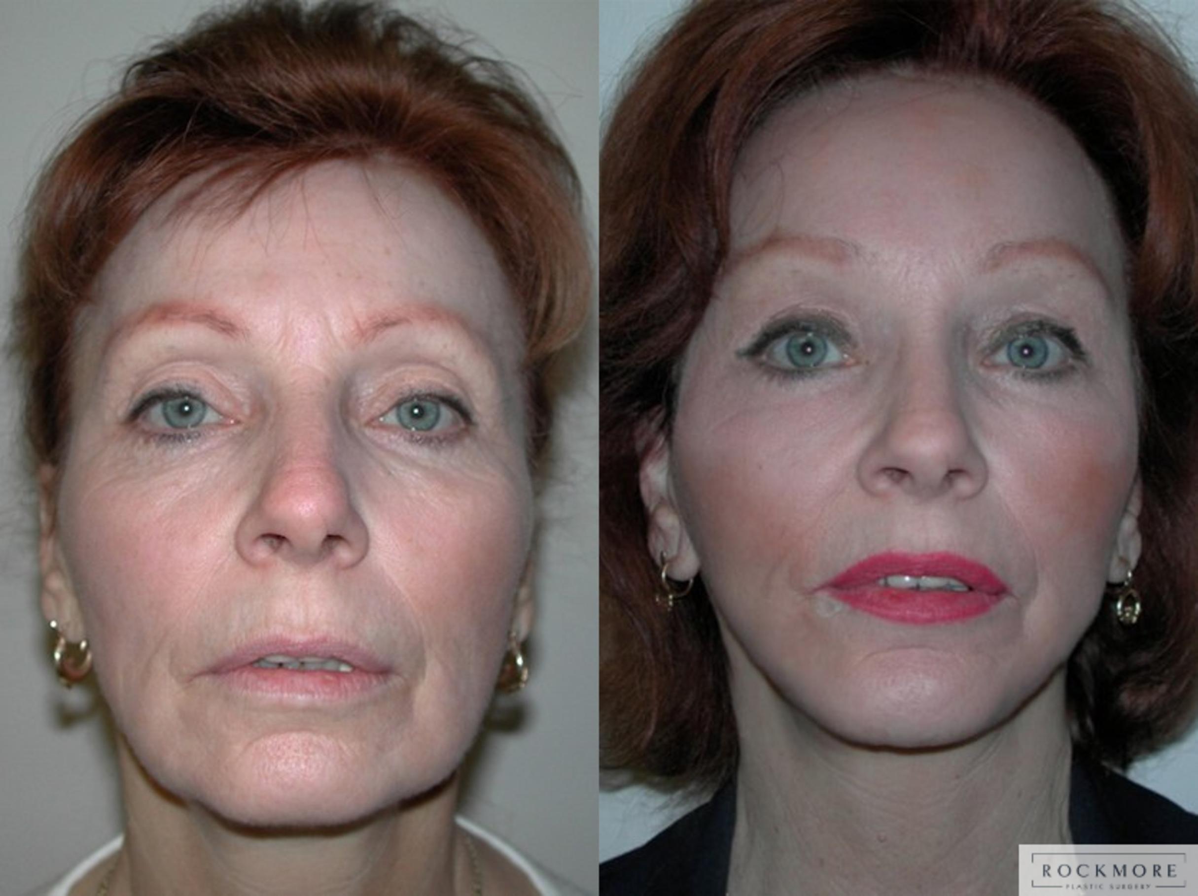 Before & After Facelift Case 42 View #1 View in Albany & Latham, New York