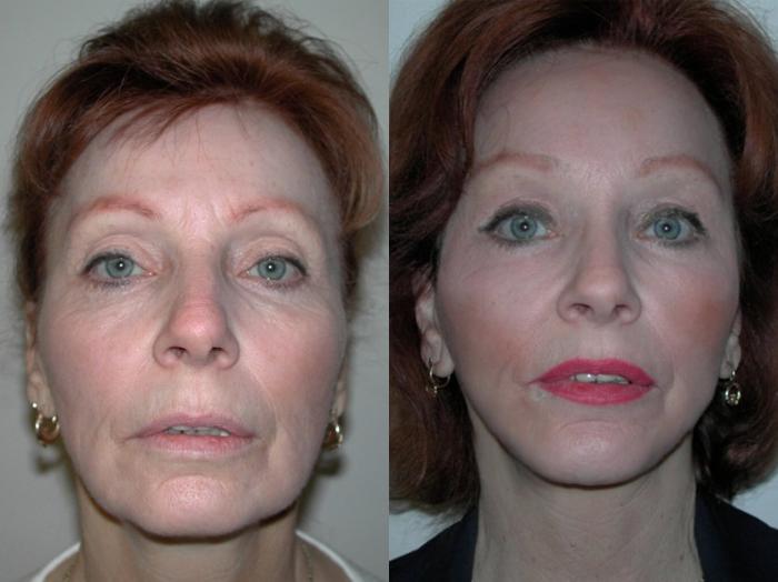 Before & After Facelift Case 42 View #1 View in Albany, Latham & Saratoga, New York