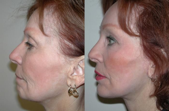 Before & After Facelift Case 42 View #2 View in Albany, Latham & Saratoga, New York