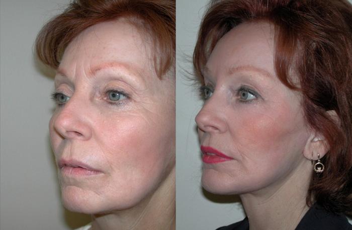 Before & After Facelift Case 42 View #3 View in Albany, Latham & Saratoga, New York