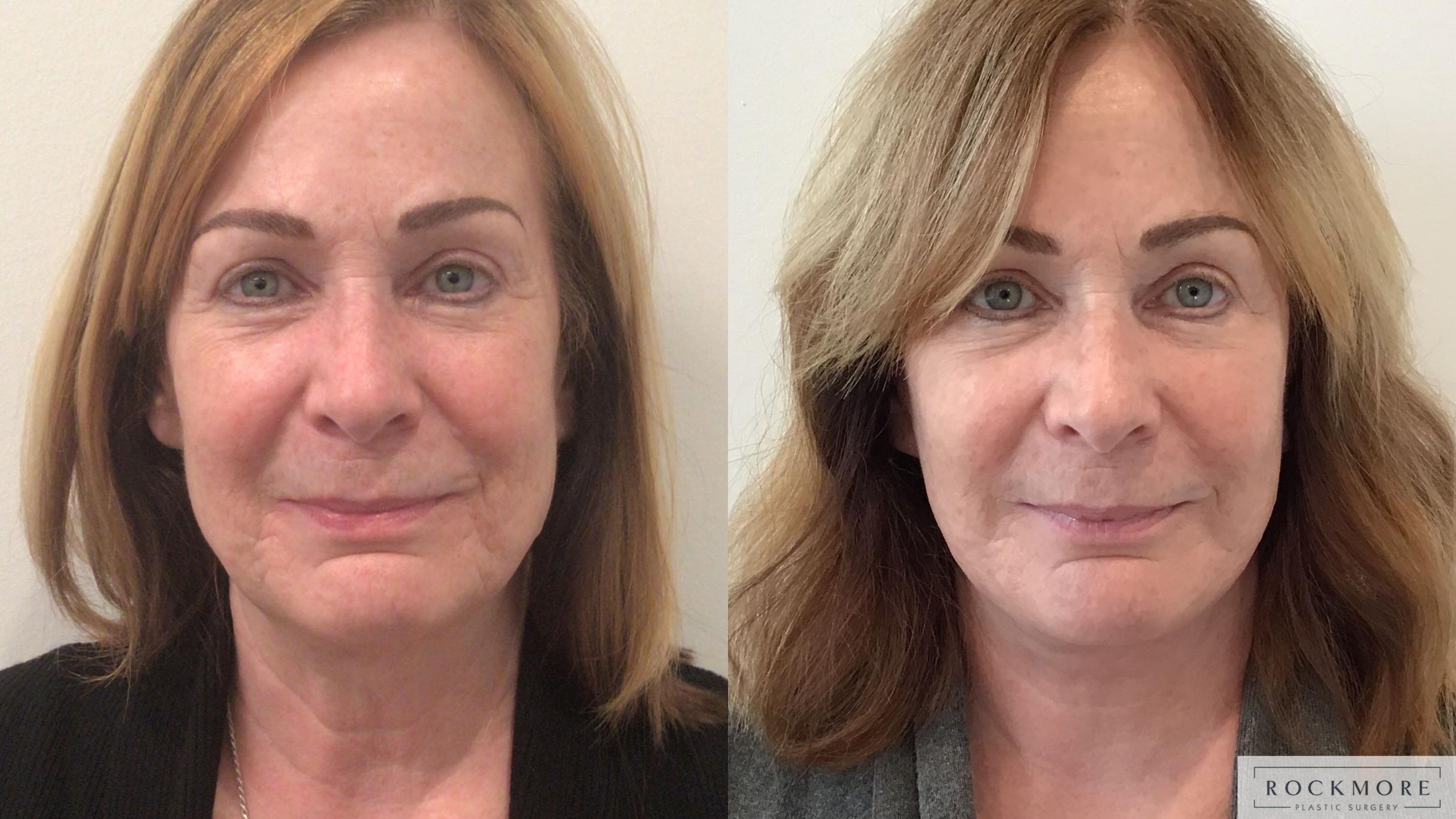 Before & After Neck Lift Case 441 Front View in Albany & Latham, New York