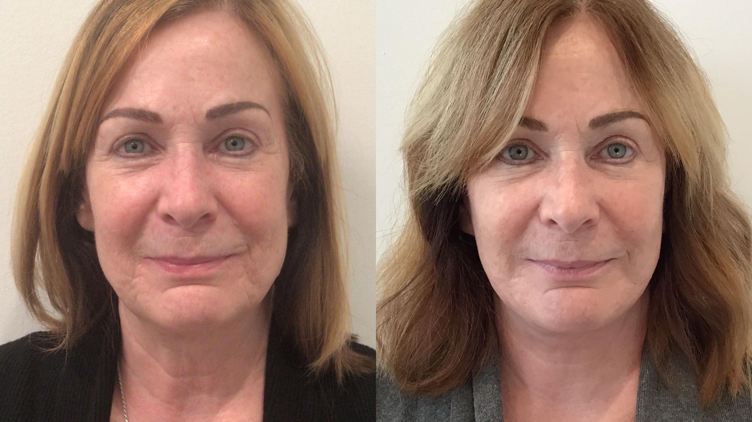 Before & After Facelift Case 441 Front View in Albany, Latham & Saratoga, New York