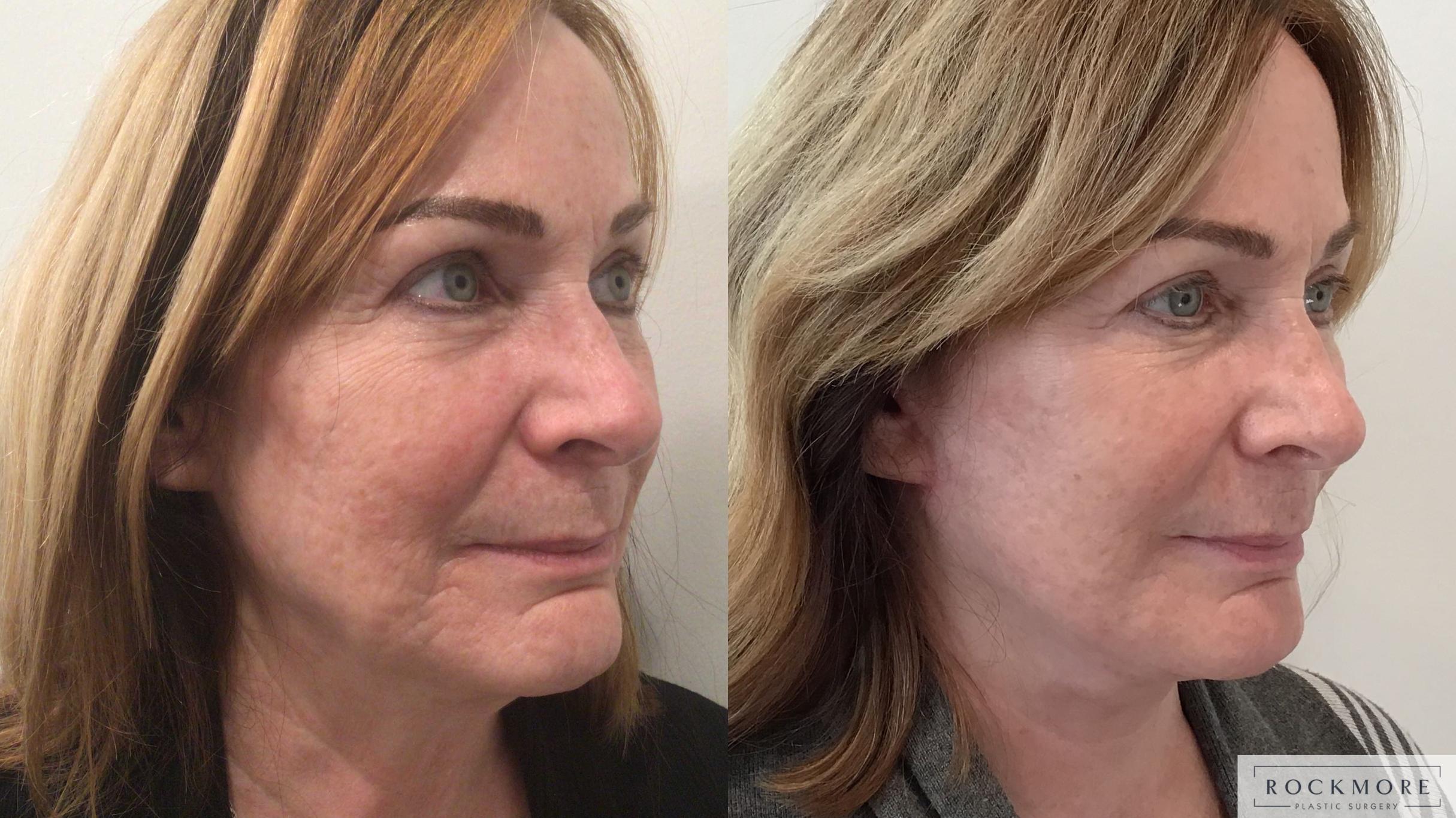 Before & After Neck Lift Case 441 Left Side View in Albany & Latham, New York