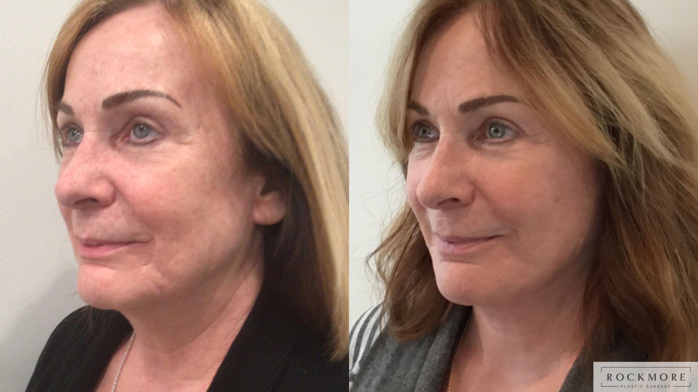 Before & After Neck Lift Case 441 Right Side View in Albany & Latham, New York