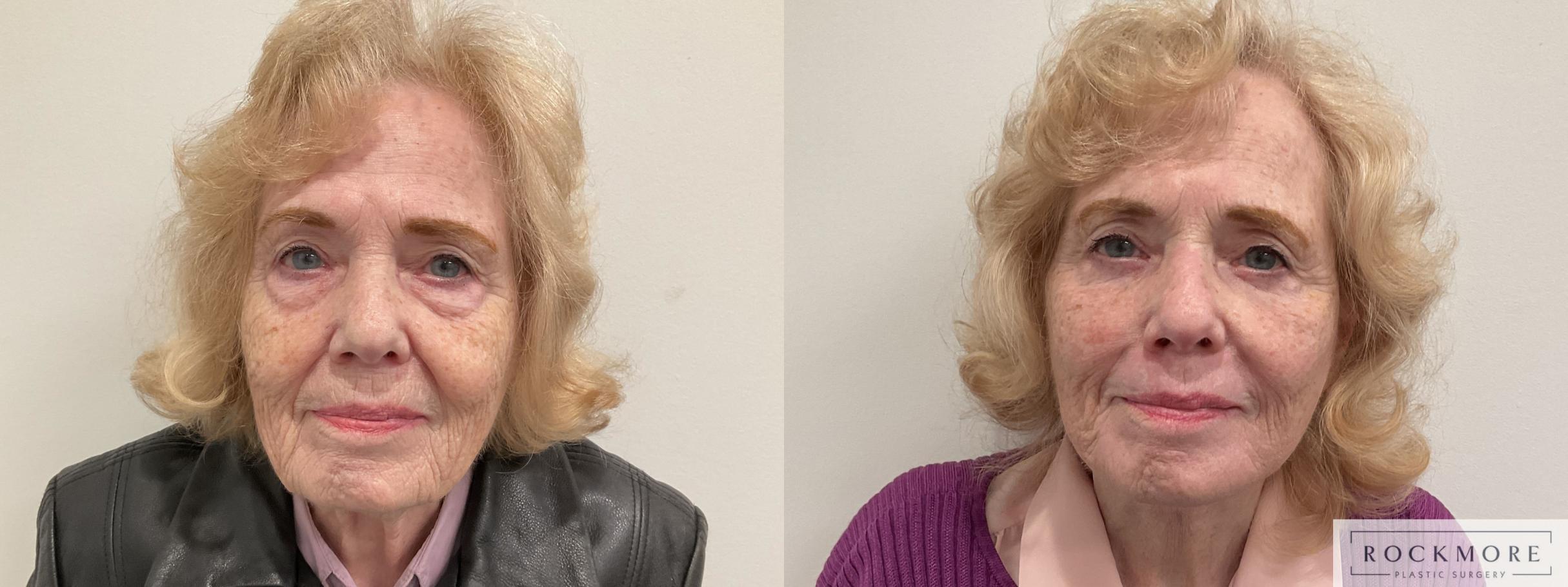 Before & After Neck Lift Case 470 Front View in Albany & Latham, New York