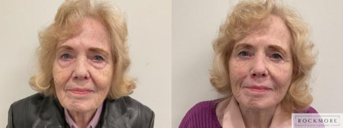 Before & After Neck Lift Case 470 Front View in Albany & Latham, New York