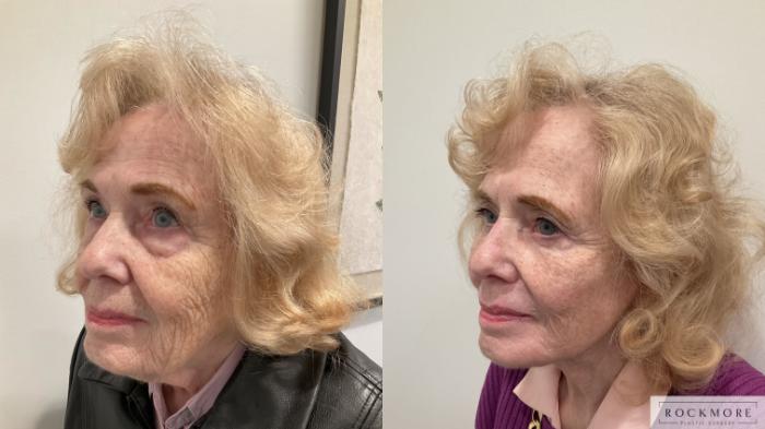 Before & After Eyelid Surgery Case 470 Left Oblique View in Albany, Latham & Saratoga, New York