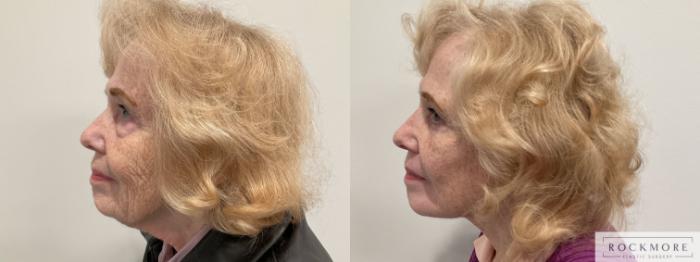 Before & After Facelift Case 470 Left Side View in Albany & Latham, New York