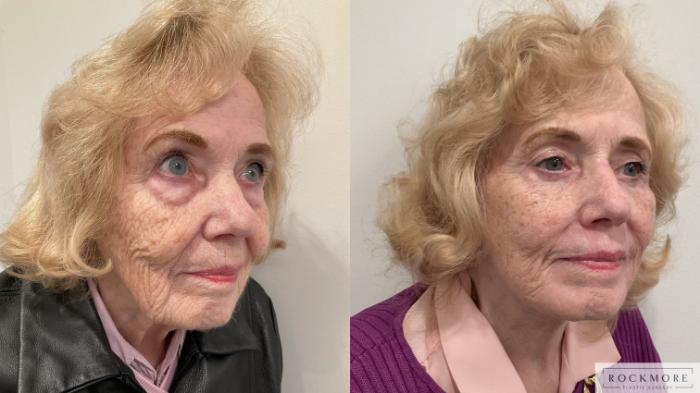 Before & After Facelift Case 470 Right Oblique View in Albany & Latham, New York