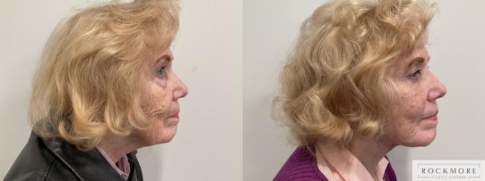 Before & After Eyelid Surgery Case 470 Right Side View in Albany, Latham & Saratoga, New York