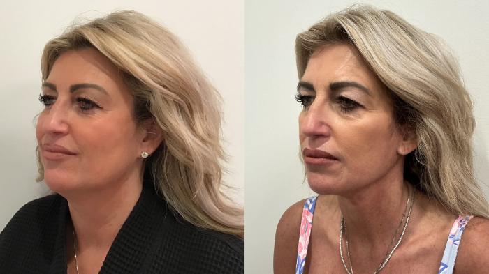 Before & After Facelift Case 476 Left Oblique View in Albany, Latham & Saratoga, New York
