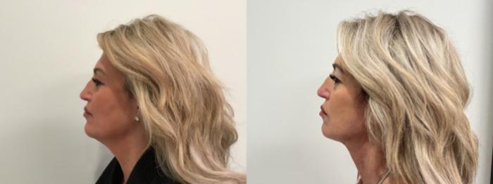 Before & After Facelift Case 476 Left Side View in Albany, Latham & Saratoga, New York
