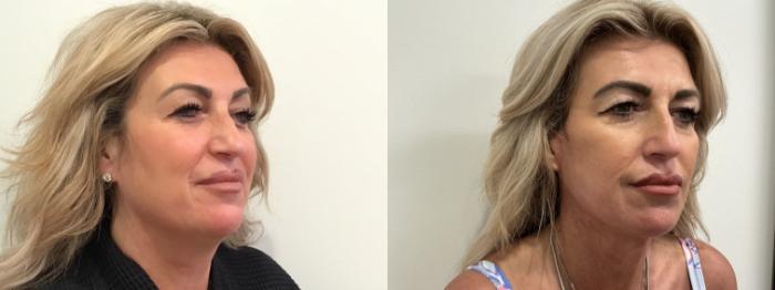 Before & After Facelift Case 476 Right Oblique View in Albany, Latham & Saratoga, New York