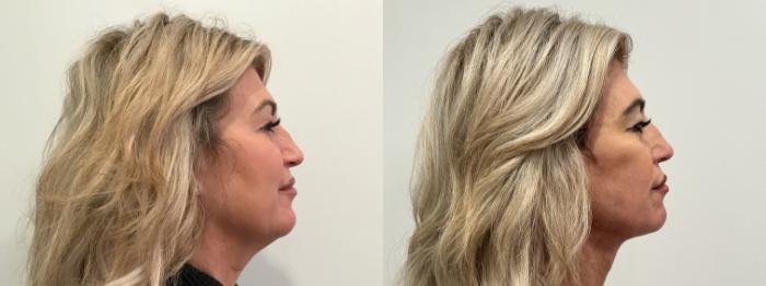 Before & After Facelift Case 476 Right Side View in Albany, Latham & Saratoga, New York