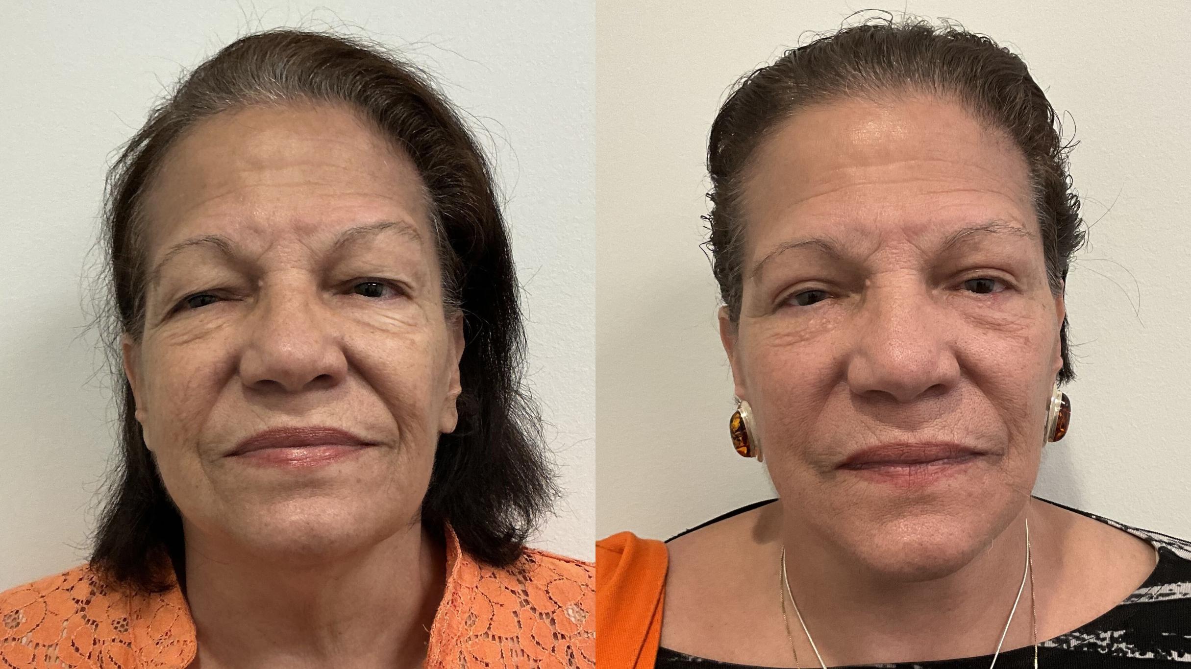 Before & After Facelift Case 509 Front View in Albany, Latham & Saratoga, New York