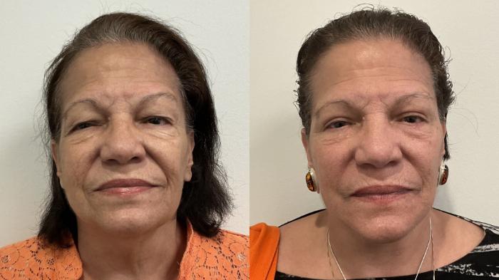 Before & After Facelift Case 509 Front View in Albany, Latham & Saratoga, New York