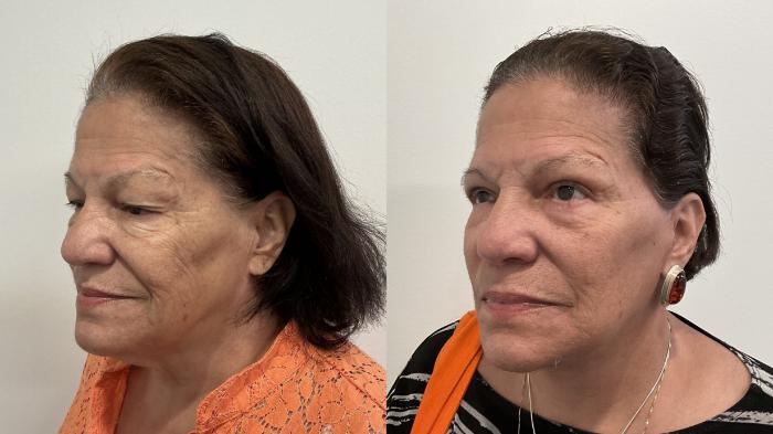 Before & After Facelift Case 509 Left Oblique View in Albany, Latham & Saratoga, New York