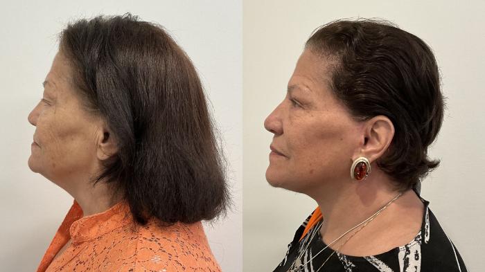 Before & After Facelift Case 509 Left Side View in Albany, Latham & Saratoga, New York