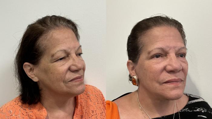 Before & After Facelift Case 509 Right Oblique View in Albany, Latham & Saratoga, New York