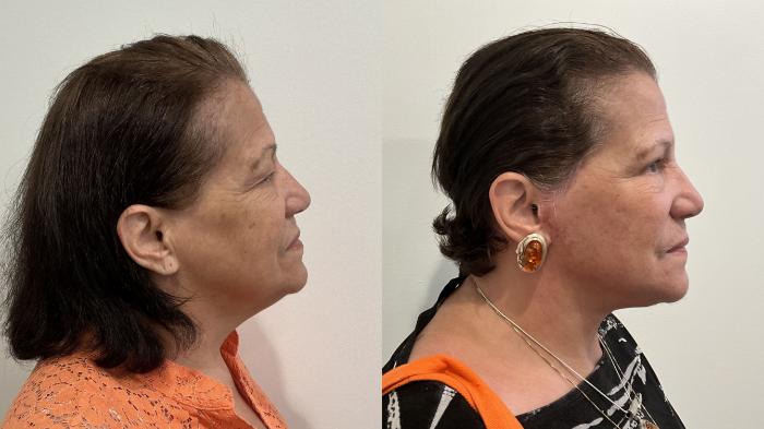 Before & After Facelift Case 509 Right Side View in Albany, Latham & Saratoga, New York