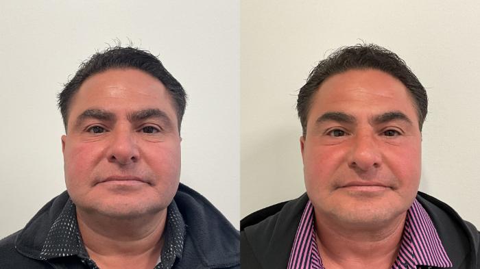 Before & After Facelift Case 510 Front View in Albany, Latham & Saratoga, New York