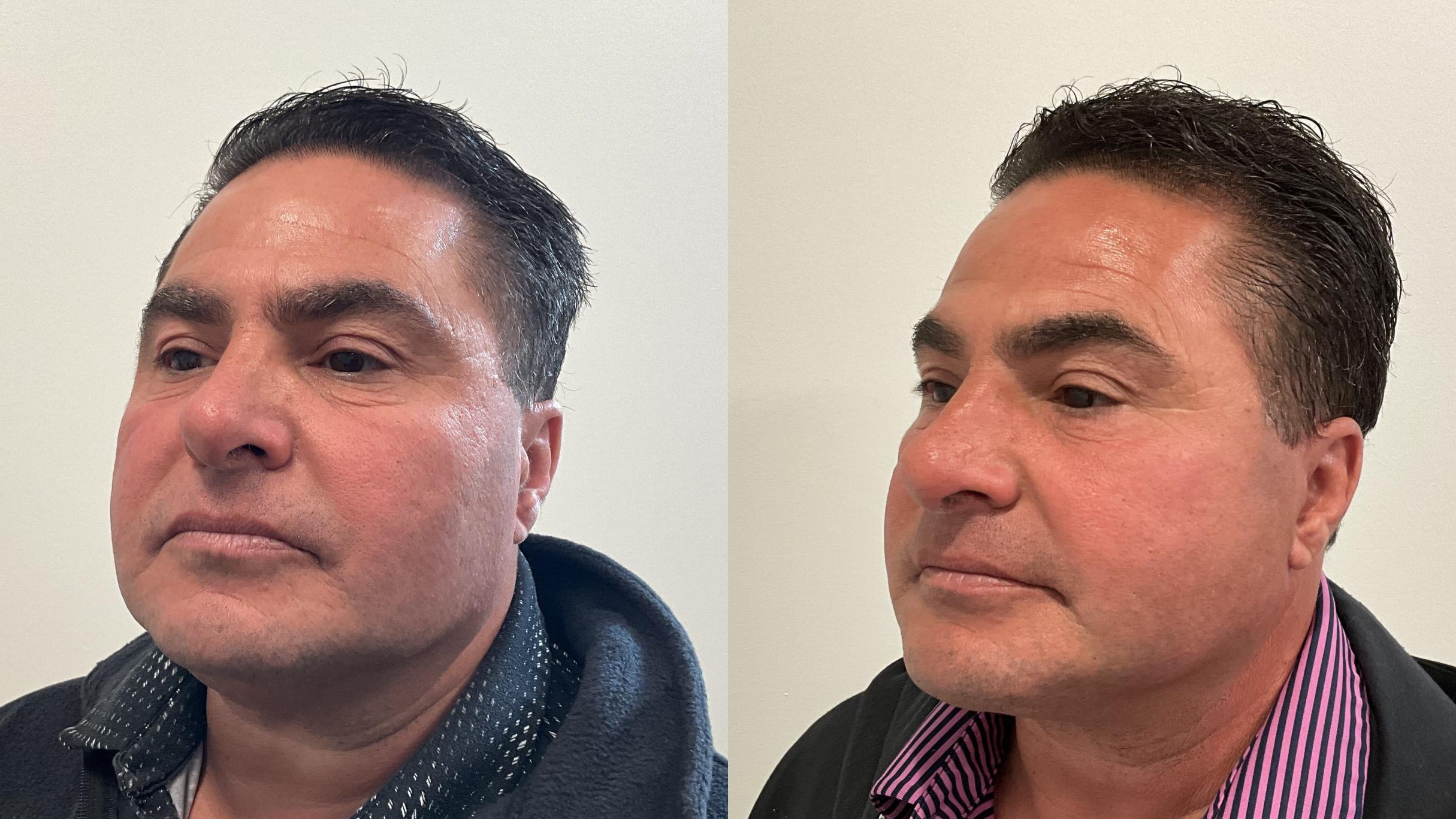 Before & After Facelift Case 510 Left Oblique View in Albany, Latham & Saratoga, New York