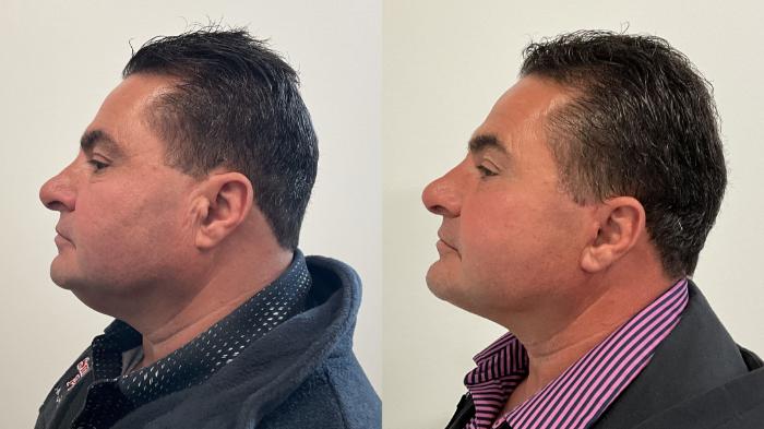Before & After Facelift Case 510 Left Side View in Albany, Latham & Saratoga, New York