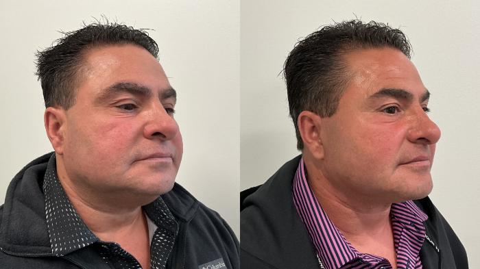 Before & After Facelift Case 510 Right Oblique View in Albany, Latham & Saratoga, New York
