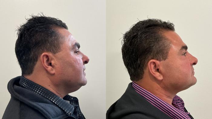 Before & After Facelift Case 510 Right Side View in Albany, Latham & Saratoga, New York