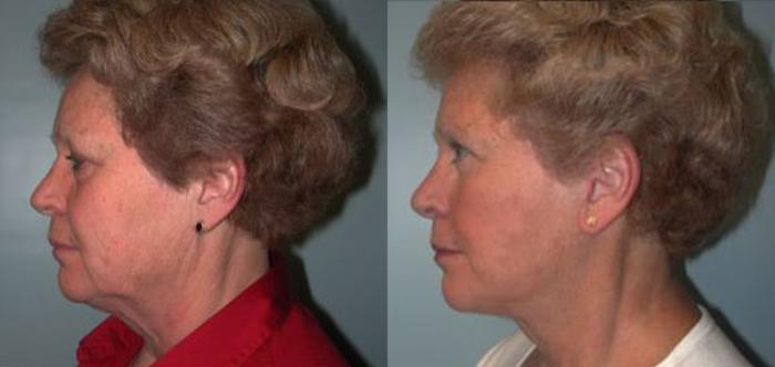 Before & After Facelift Case 68 View #3 View in Albany, Latham & Saratoga, New York