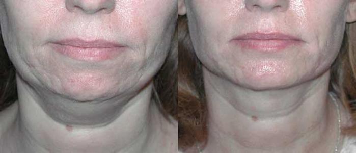 Before & After Facial Implants Case 19 View #1 View in Albany, Latham & Saratoga, New York