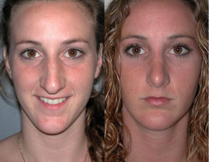 Before & After Facial Implants Case 48 View #1 View in Albany, Latham & Saratoga, New York