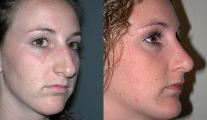 Before & After Facial Implants Case 48 View #2 View in Albany, Latham & Saratoga, New York