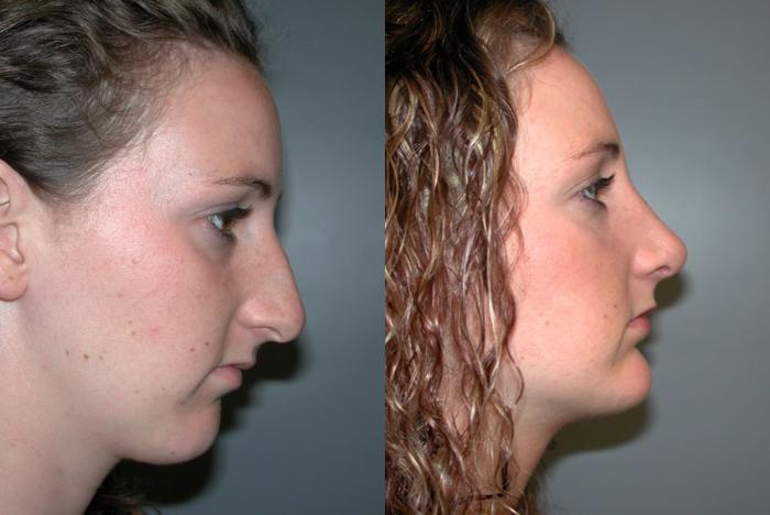 Before & After Facial Implants Case 48 View #3 View in Albany, Latham & Saratoga, New York