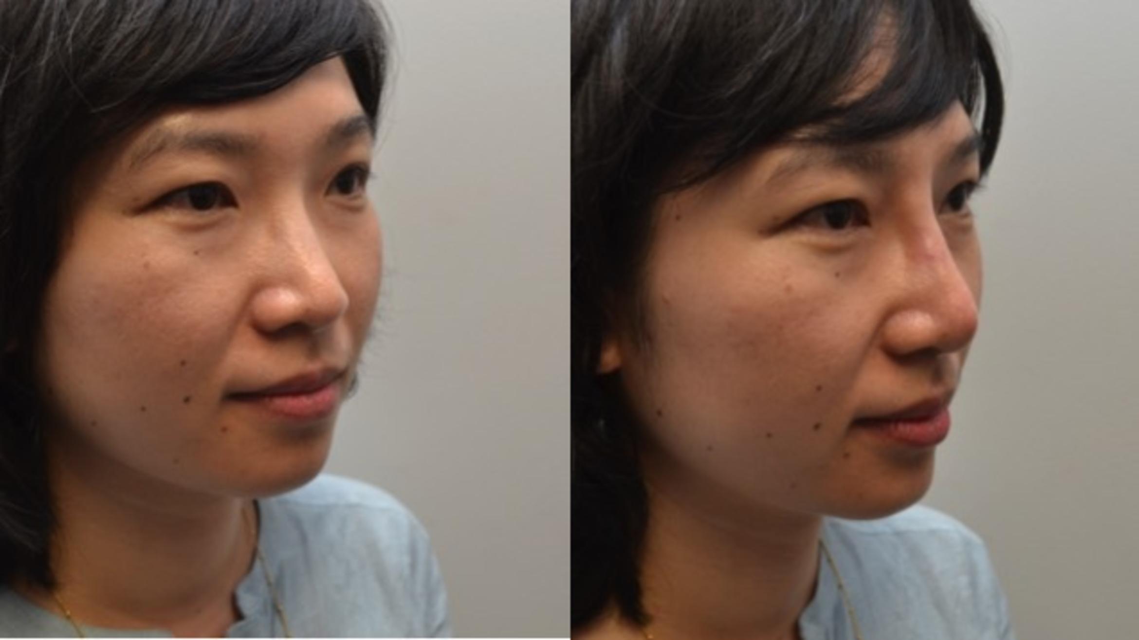 Before & After Rhinoplasty Case 234 View #5 View in Albany & Latham, New York